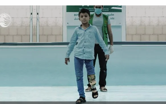 الطفل اليمن (قيس فياض).. ورحلة معاناة مع القدم المشوّهة
