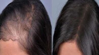 صورة أهم الأمراض المسببة لتساقط الشعر عند النساء وطرق العلاج