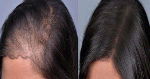 أهم الأمراض المسببة لتساقط الشعر عند النساء وطرق العلاج